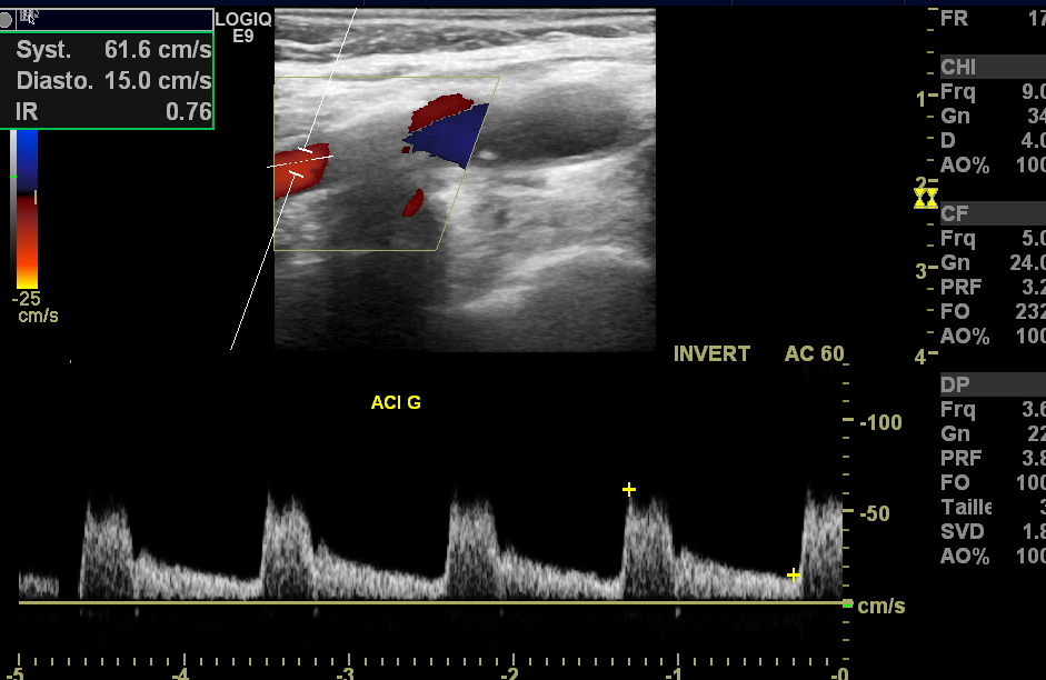 Echo Doppler - Coradix