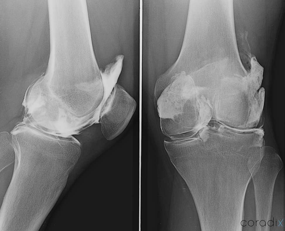 Arthrographie - Coradix