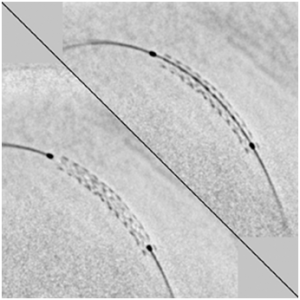 stents-300x300