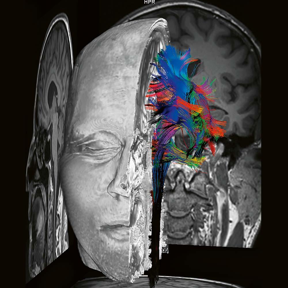 siemens-healthineers-mri-biomatrix-dti-fibertracking